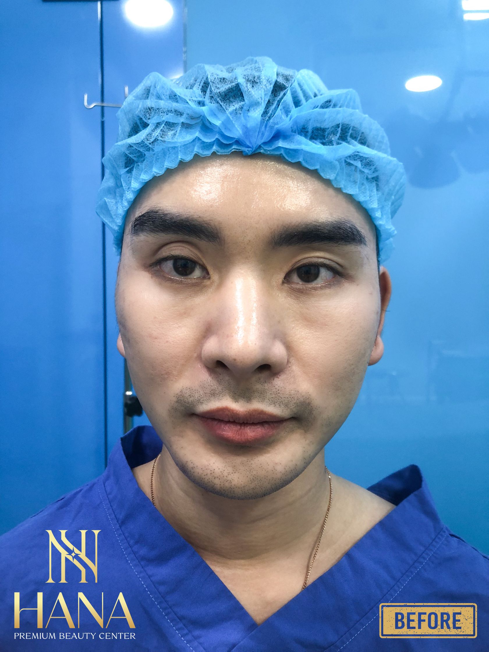 Cấy Mỡ Mí Mắt