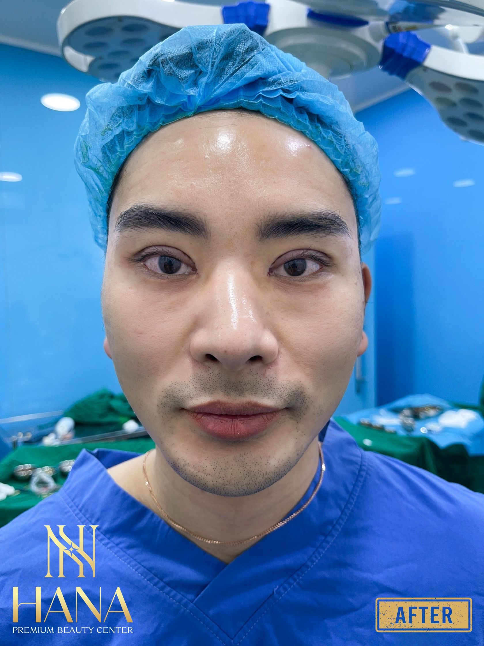 Cấy Mỡ Mí Mắt