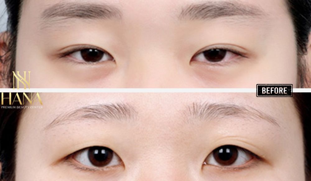 Mở Rộng Góc Mắt