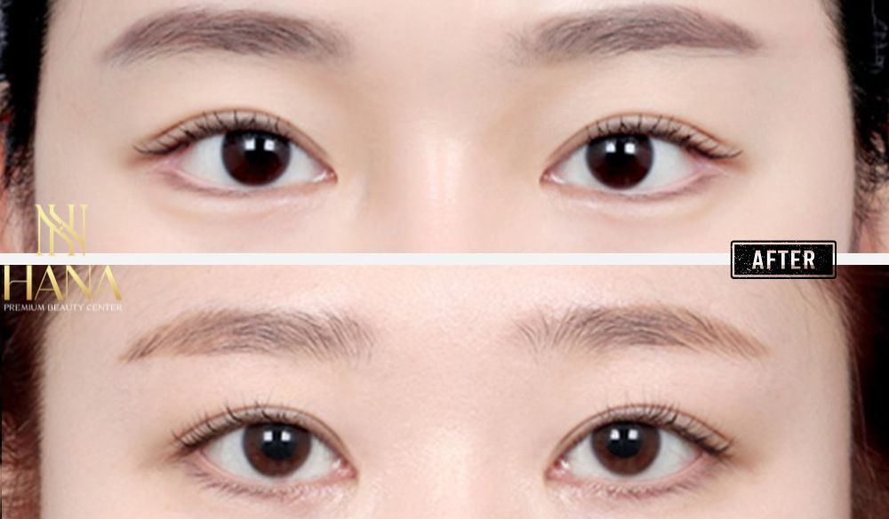 Mở Rộng Góc Mắt