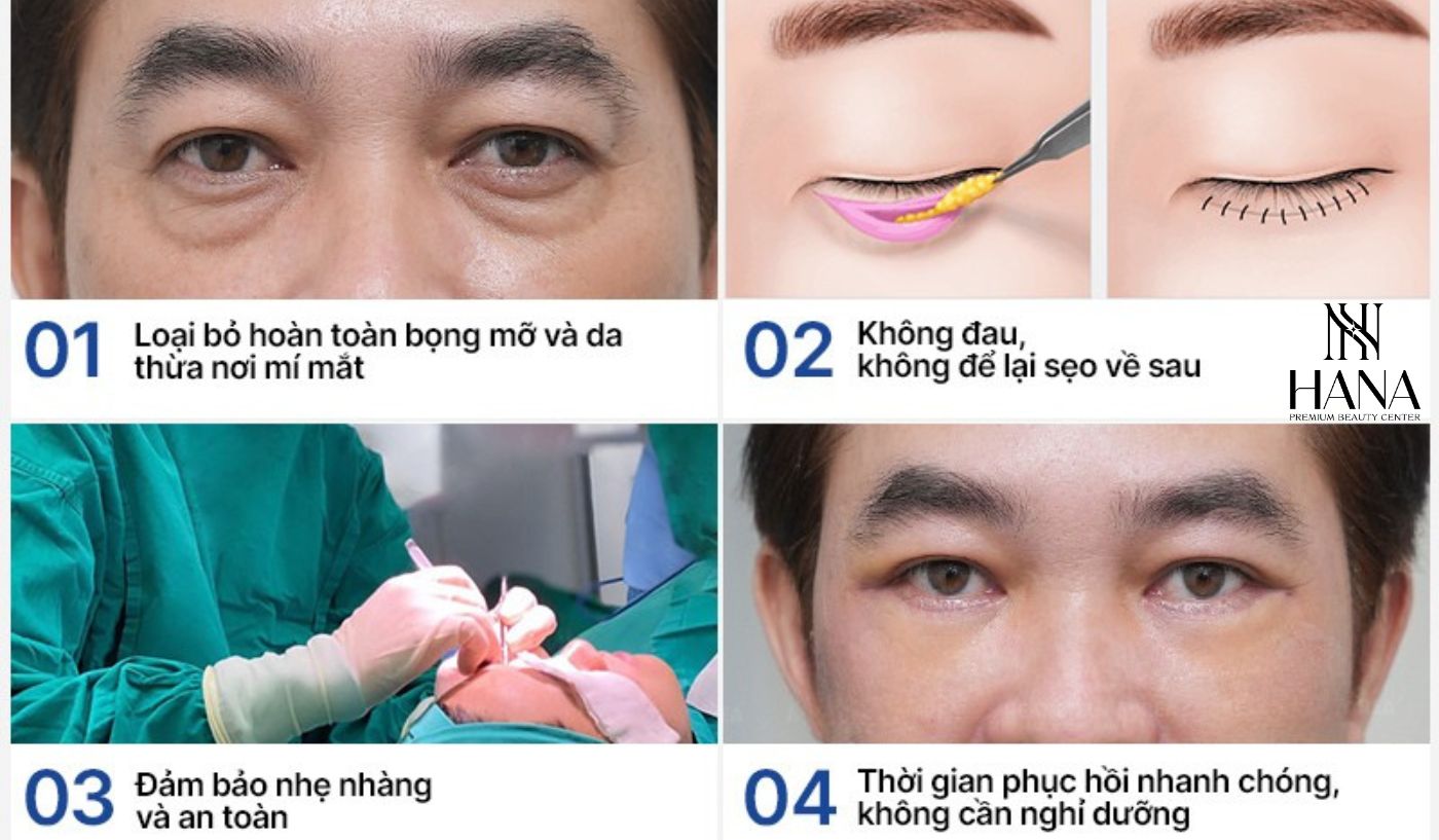 Lấy Mỡ Bọng Mắt