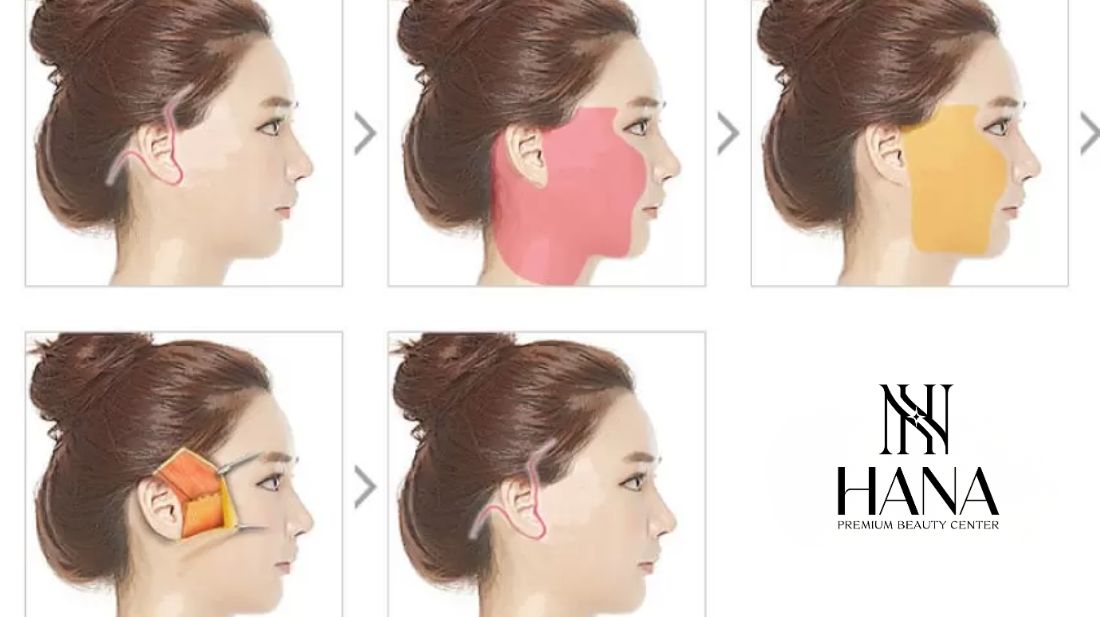 Căng da mặt SMAS PRO: Công nghệ diệu kỳ, giữ mãi nét xuân