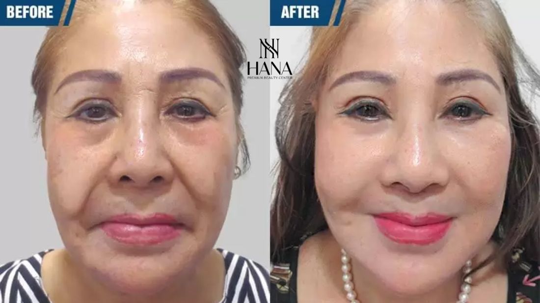 Căng da mặt SMAS PRO: Công nghệ diệu kỳ, giữ mãi nét xuân
