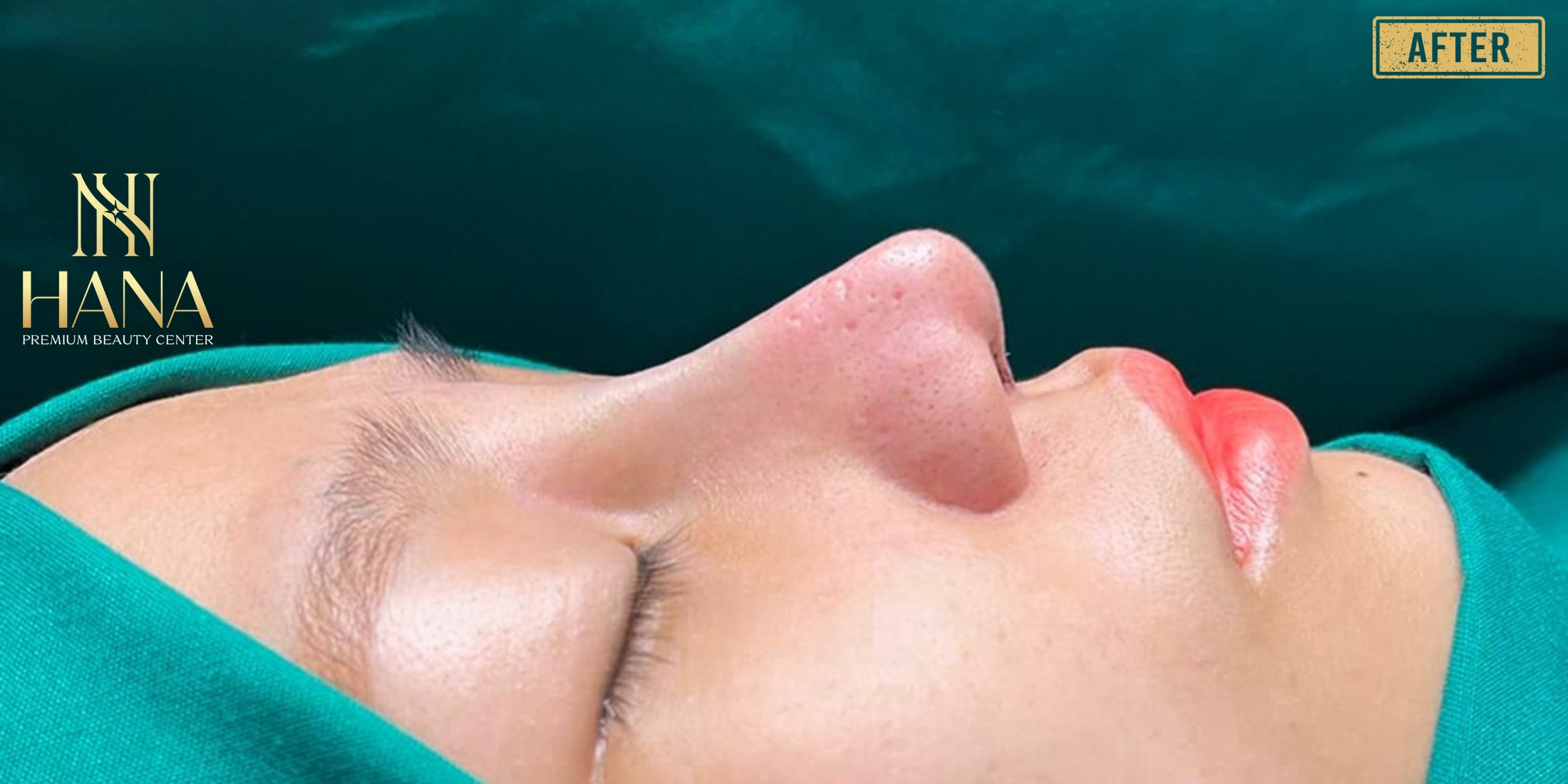 Nâng Mũi Siêu Cấu Trúc