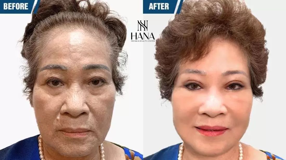 Căng da mặt SMAS PRO: Công nghệ diệu kỳ, giữ mãi nét xuân