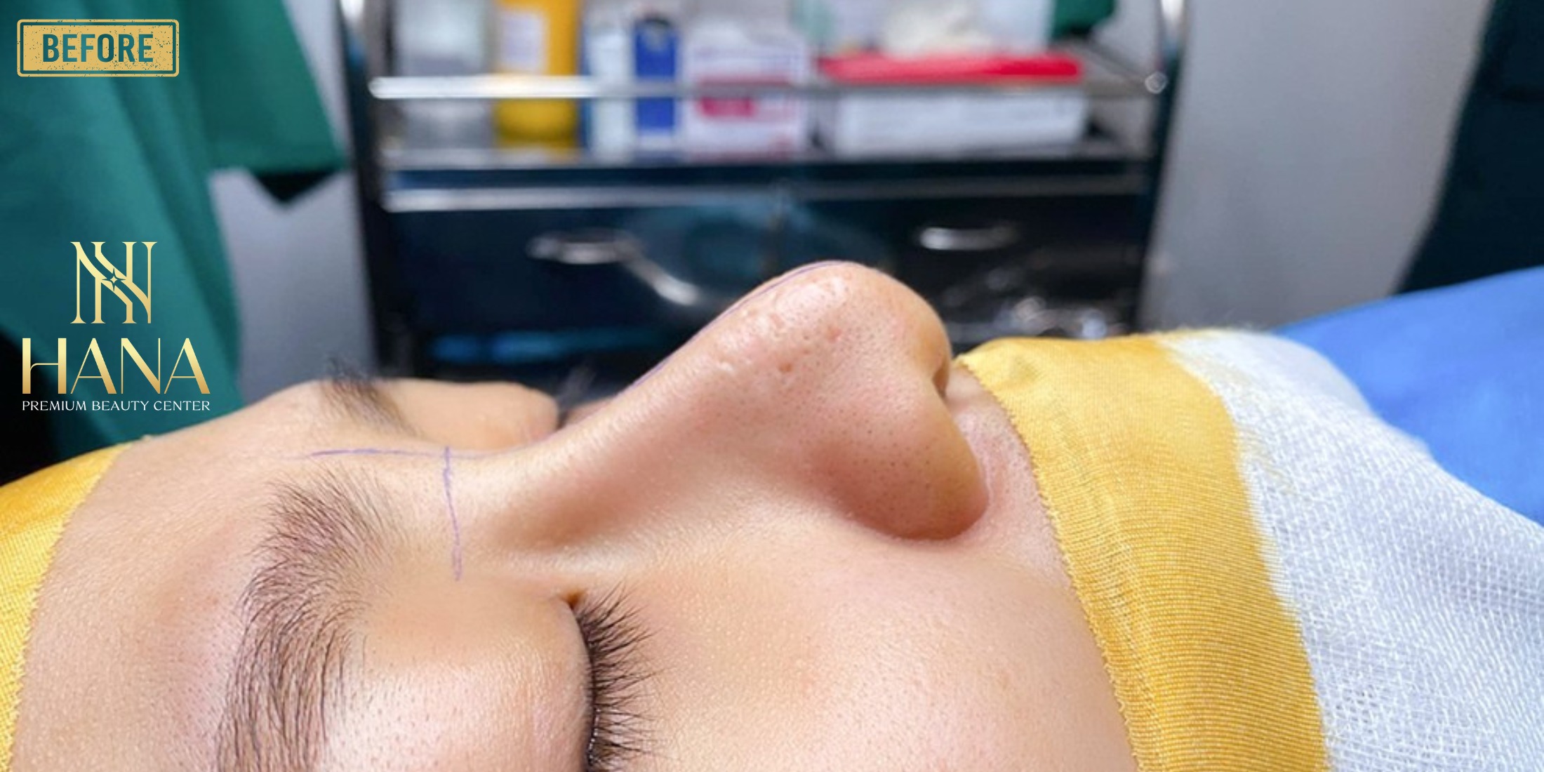 Nâng Mũi Siêu Cấu Trúc