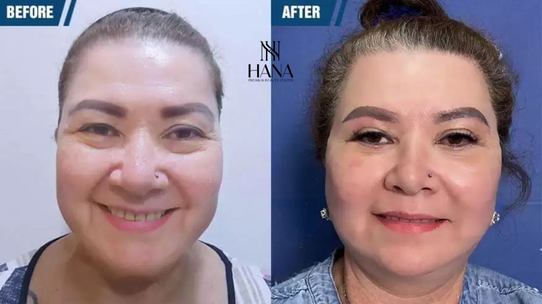 Căng da mặt SMAS PRO: Công nghệ diệu kỳ, giữ mãi nét xuân