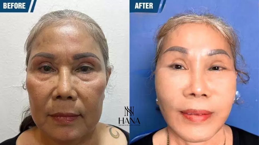 Căng da mặt SMAS PRO: Công nghệ diệu kỳ, giữ mãi nét xuân