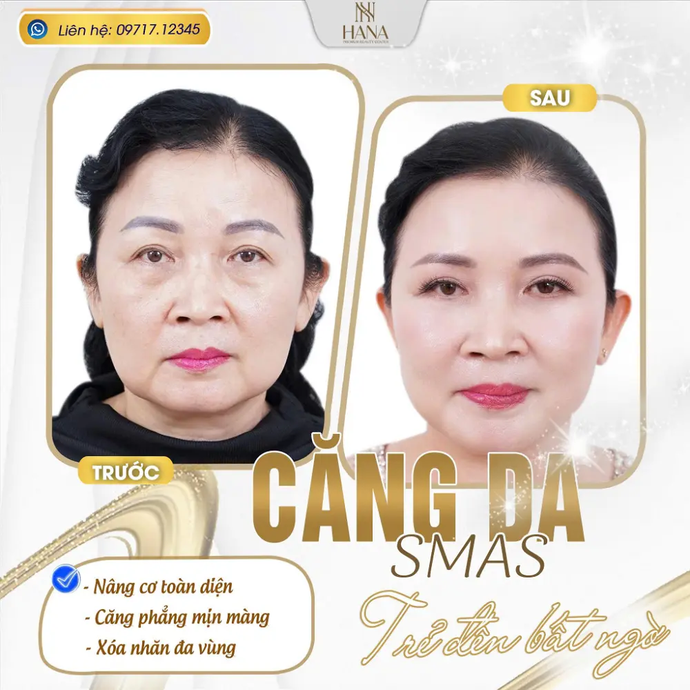 Căng da mặt