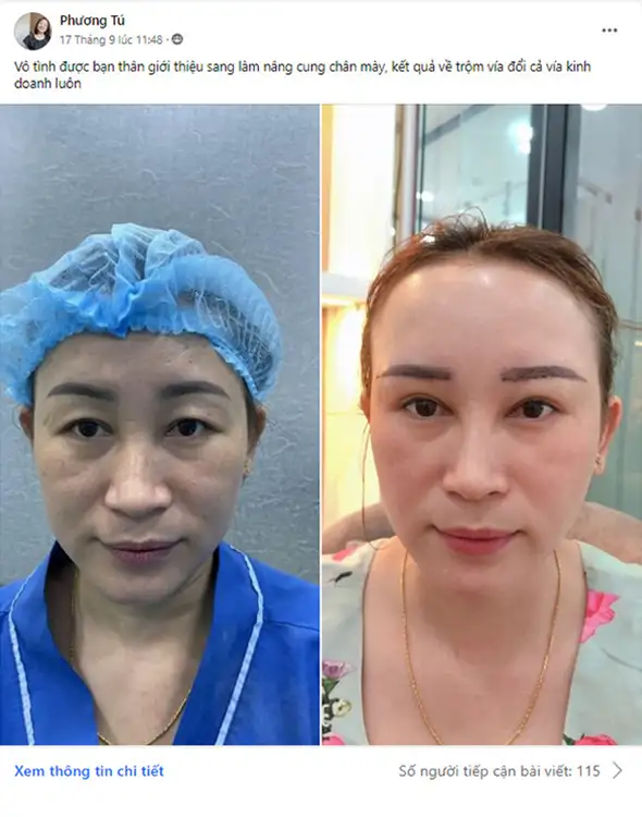 Cắt mí mắt