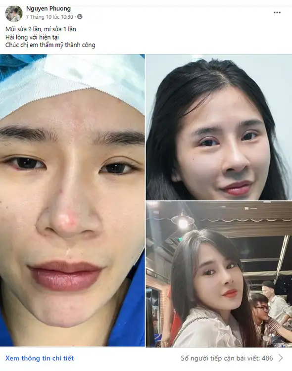 Cắt mí mắt