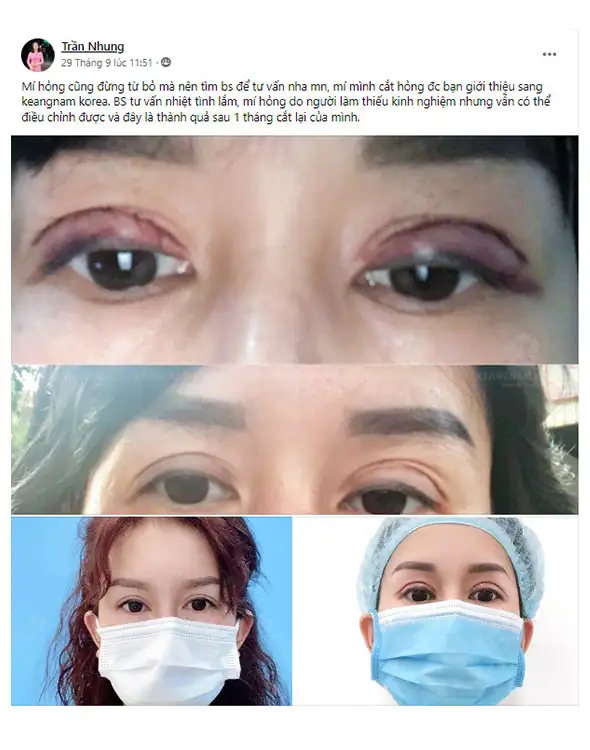 Cắt mí mắt