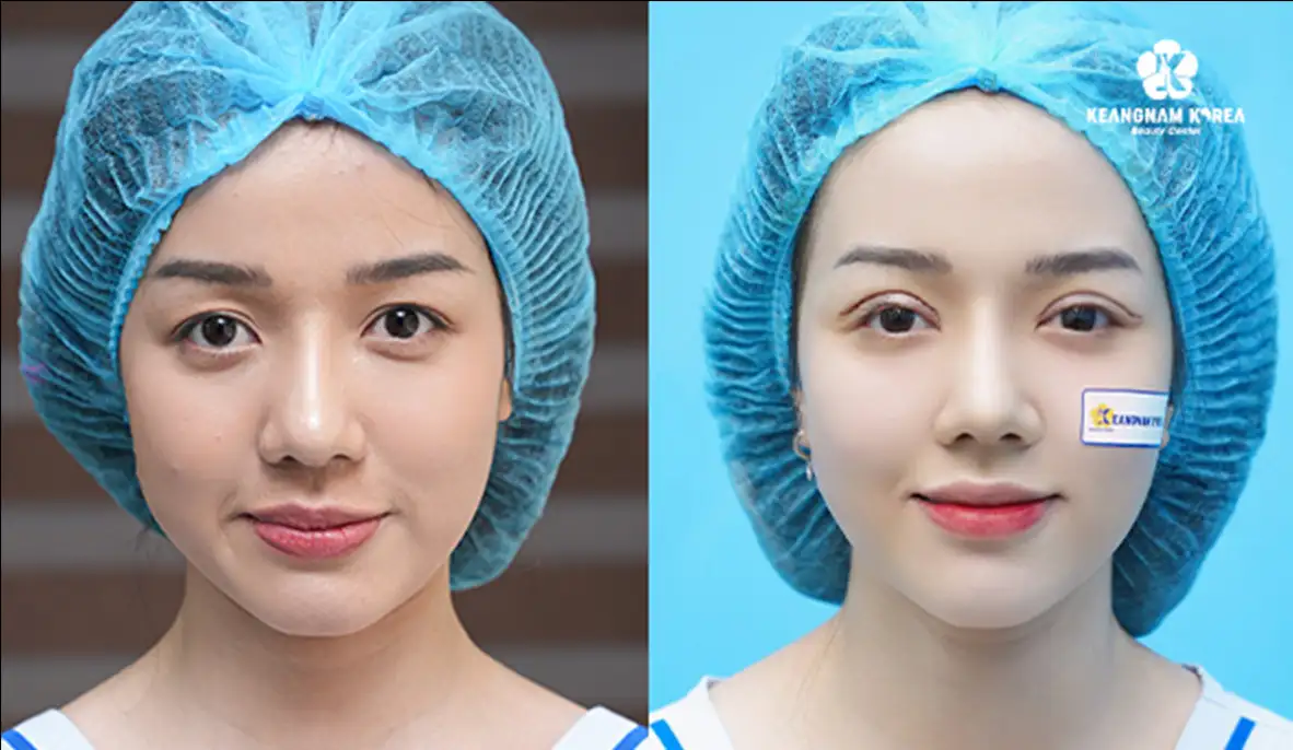 Cắt mí mắt