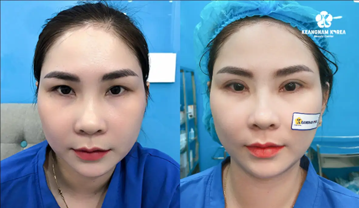 Cắt mí mắt