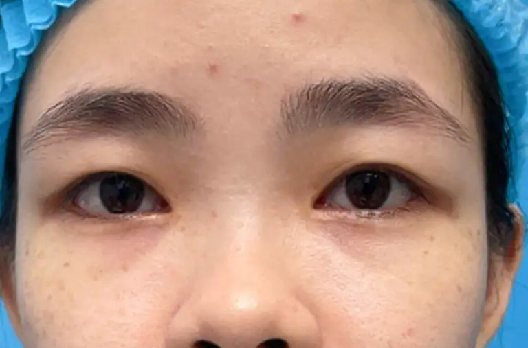 Cắt mí mắt
