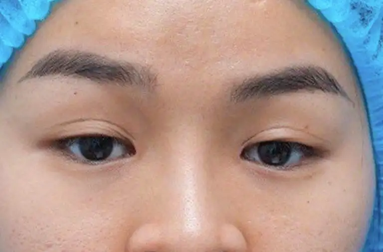 Cắt mí mắt