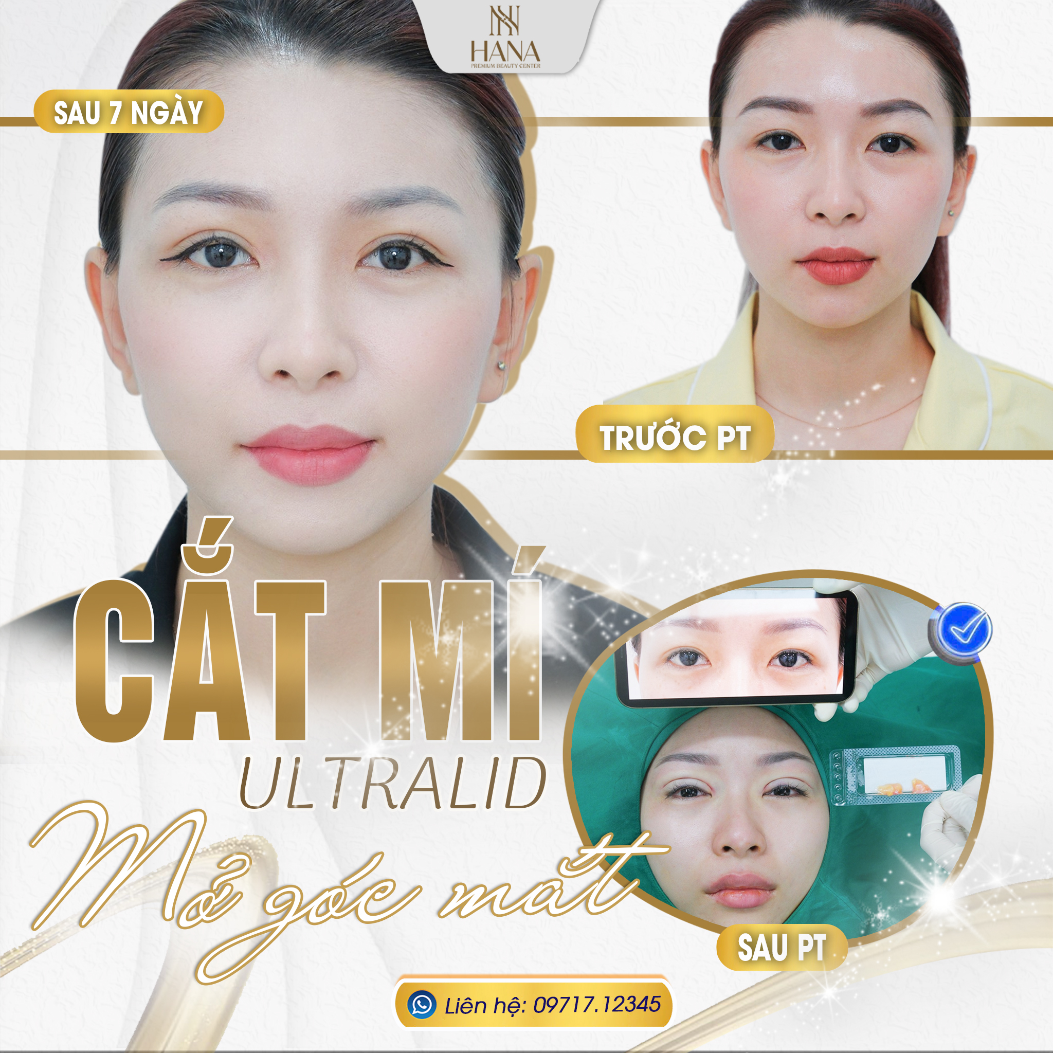 Cắt mí - Hana Premium