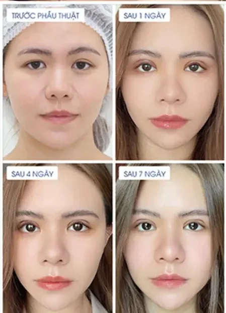 Cắt mí mắt