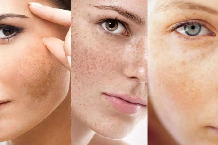 TRỊ NÁM KHÔNG KHÓ, CÁI KHÓ LÀ PHẢI “TRỊ” SAO CHO ĐÚNG!