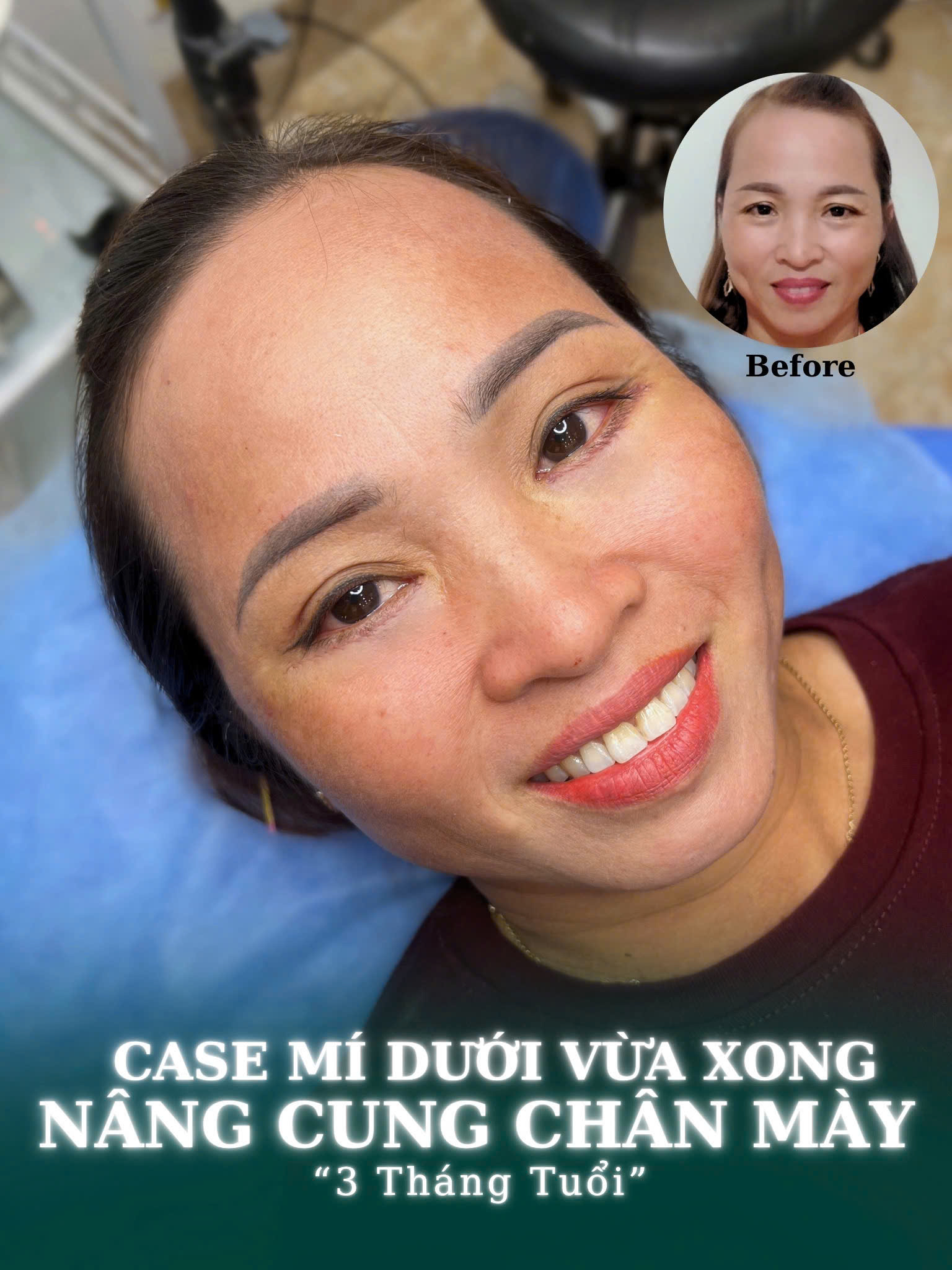 Nâng Cung Mày Giấu Chỉ