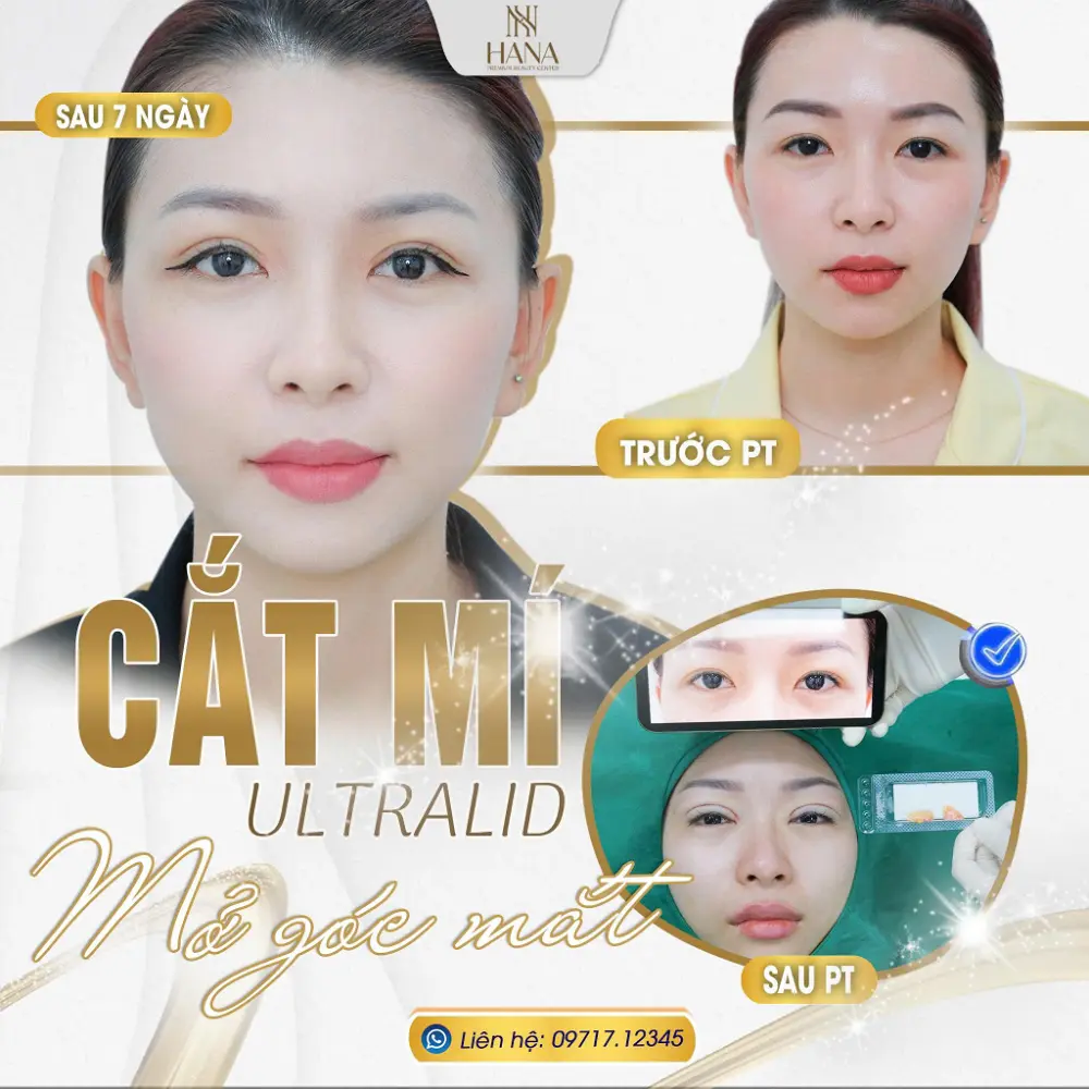 Cắt mí