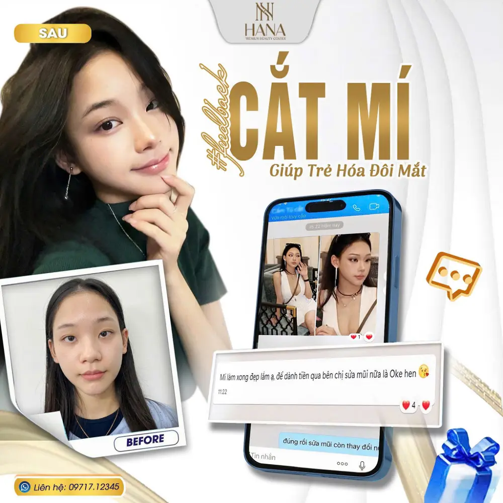 Cắt mí